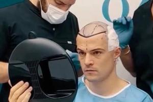 瑞士媒體：32歲的瑞士國家隊(duì)隊(duì)長扎卡在科索沃接受了植發(fā)手術(shù)